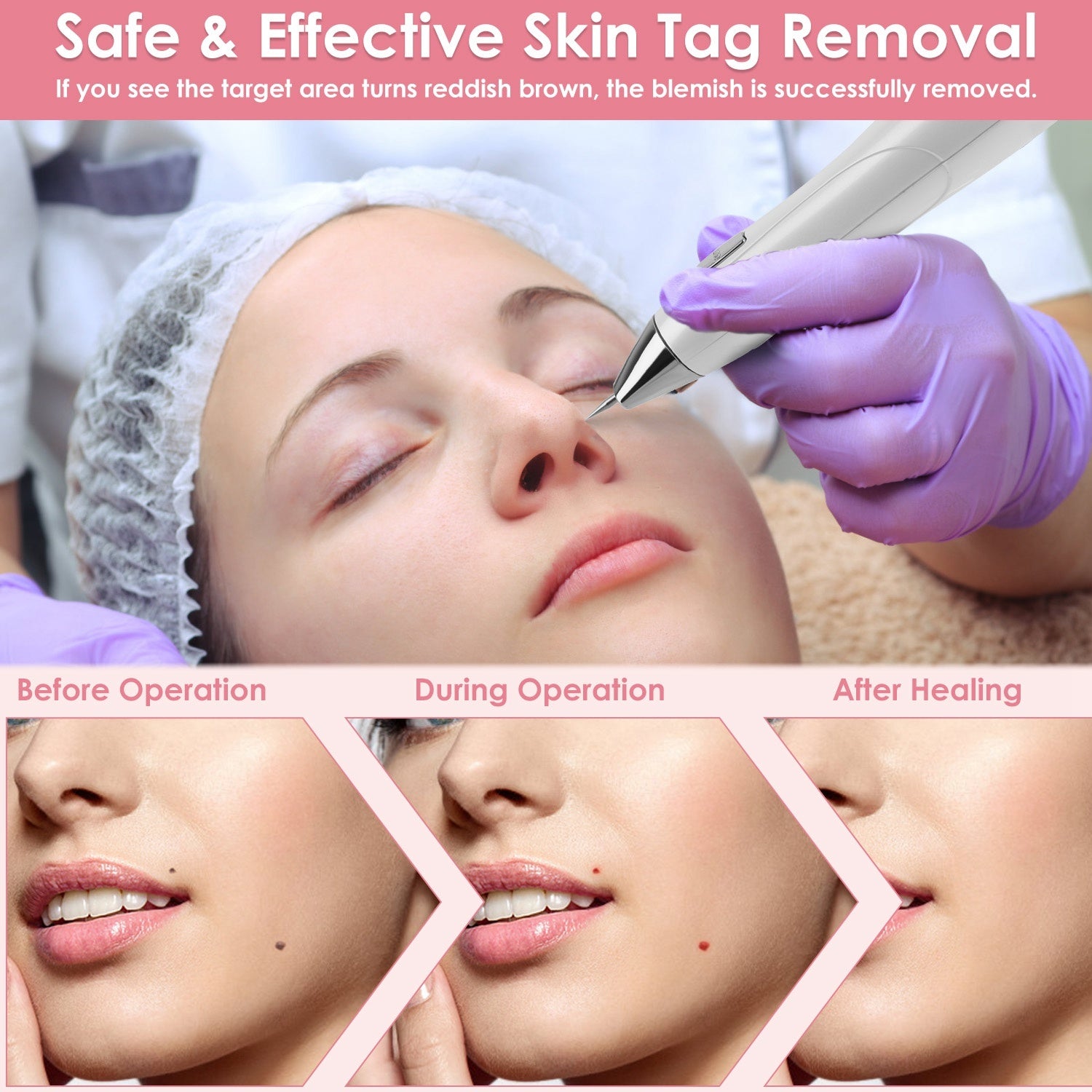 1Pc Skin Tag Remover Skin Tag Repair Kit Tattoo Freckle Wart Mole Remover Pen With 9 Intensity Levels 10 Fine Needles 3 Coarse Needles